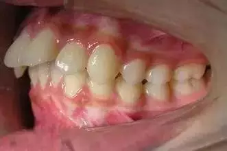 暂不处理;严重者,表现为个别或多个牙齿在各个方向的错位;而且牙齿