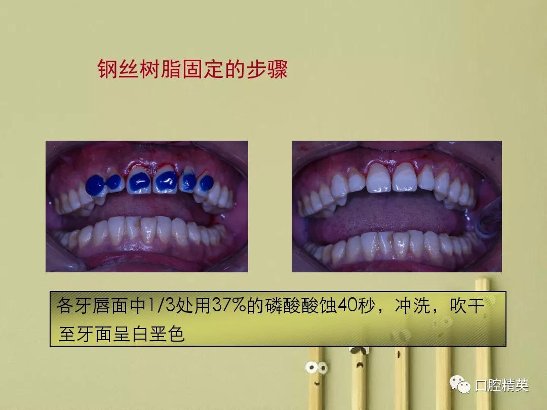 牙外伤的固定技术和牙髓治疗