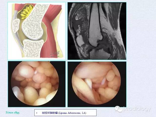 ecr讲座膝关节脂肪垫国内难的一见