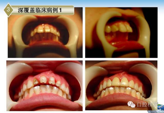 前牙深覆合深覆盖修复治疗