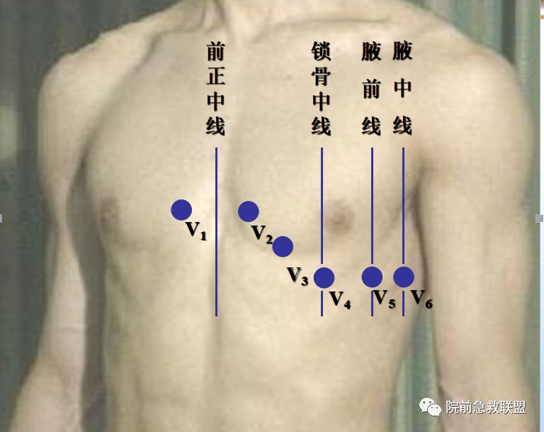 心电图】12导与18导心电图机的区别_导联线