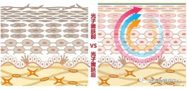 色素的原理_激光治疗色素病变原理(3)