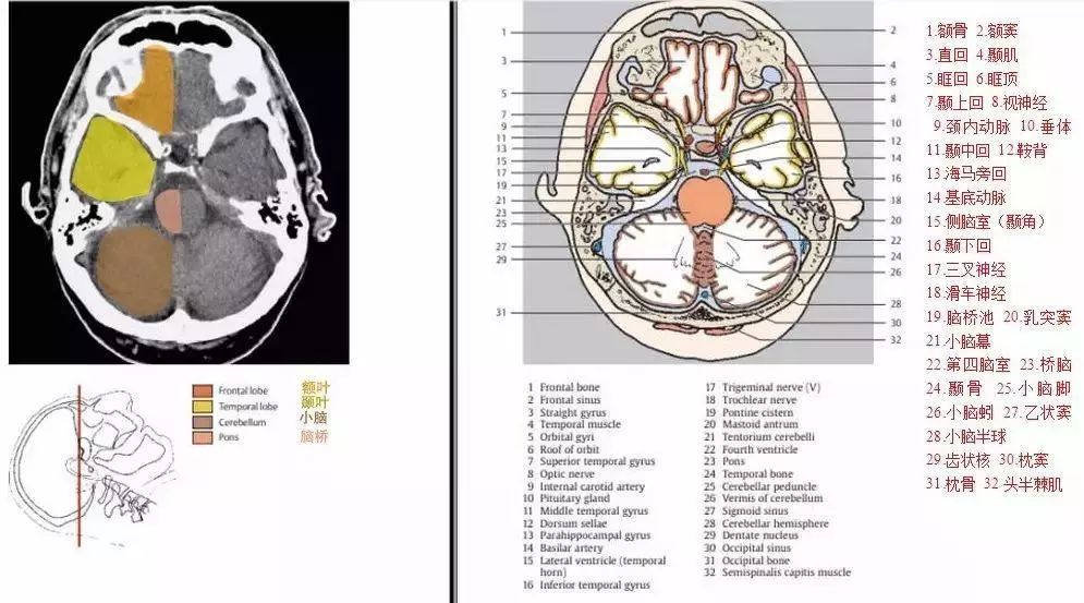 珍藏| 颅脑ct断面解剖彩色图谱_横断