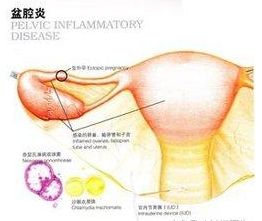 白带清洁度3度做了流产,会不会影响以后怀孕?