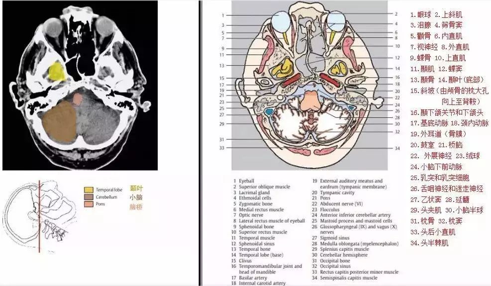 经延髓的横断层面及ct图经外耳道的横断层面及ct图【书籍推荐】《ct