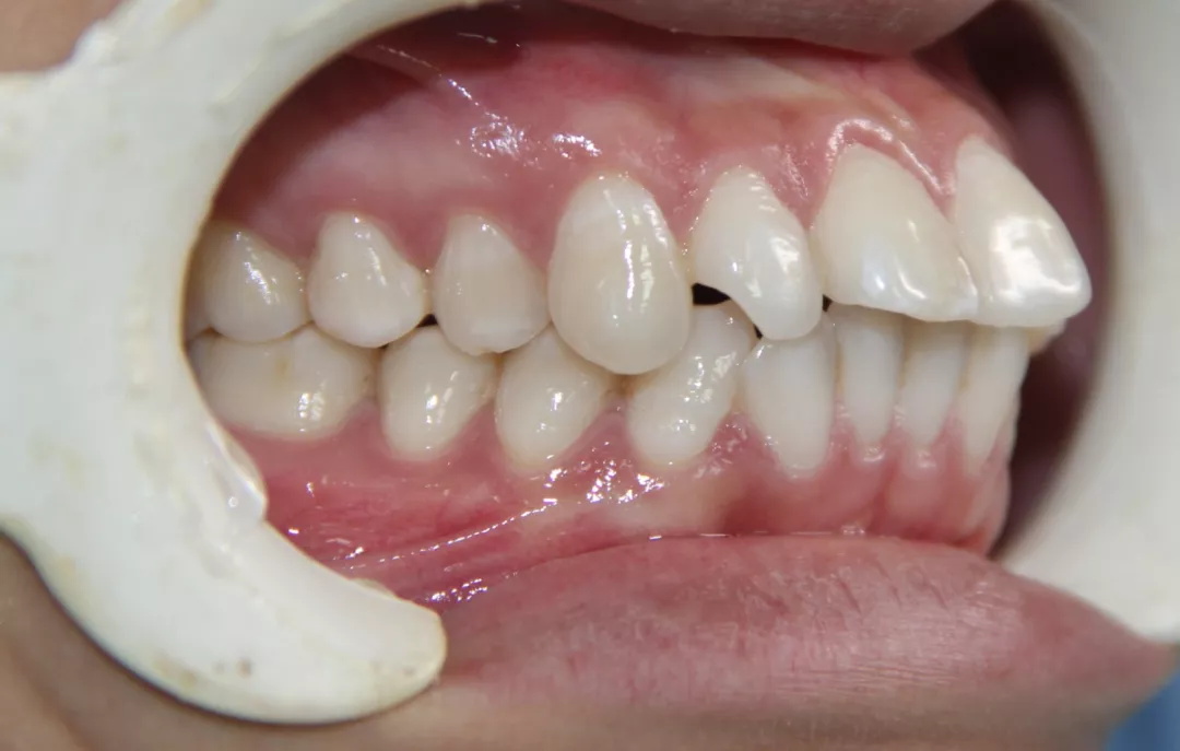 做牙齿矫正为什么要拔牙?拔牙矫正会不会有风险?