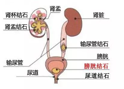 坐过山车可以治疗肾结石?科学家也开始搞笑了