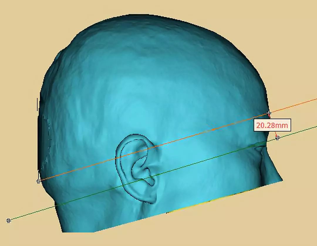 眉弓外侧缘至外耳孔区域(也只能是这个区域)3d看穿刺方向及平面3d研究