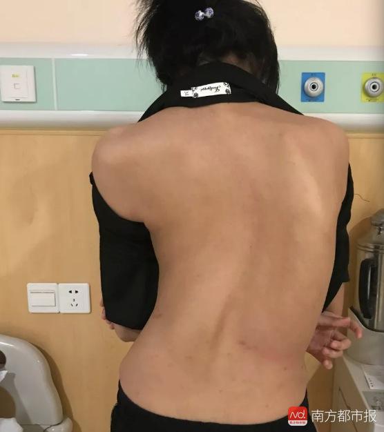 珠海12岁女孩脊柱扭成"s"型,9小时手术后"长高"5cm