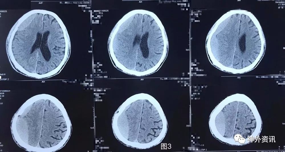 外院第1次术后头颅ct提示:右侧额颞顶枕慢性硬膜下血肿钻孔引流术后