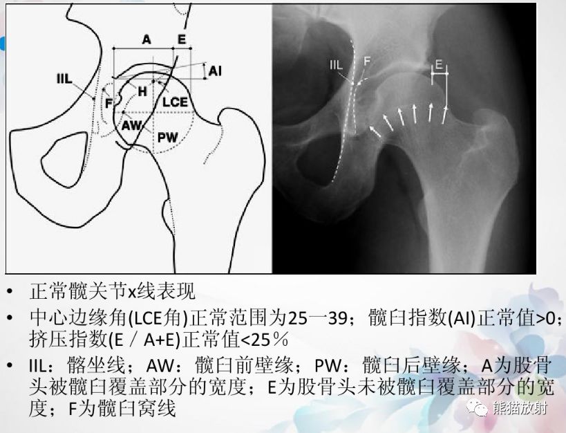 髋臼过深,前突,后倾