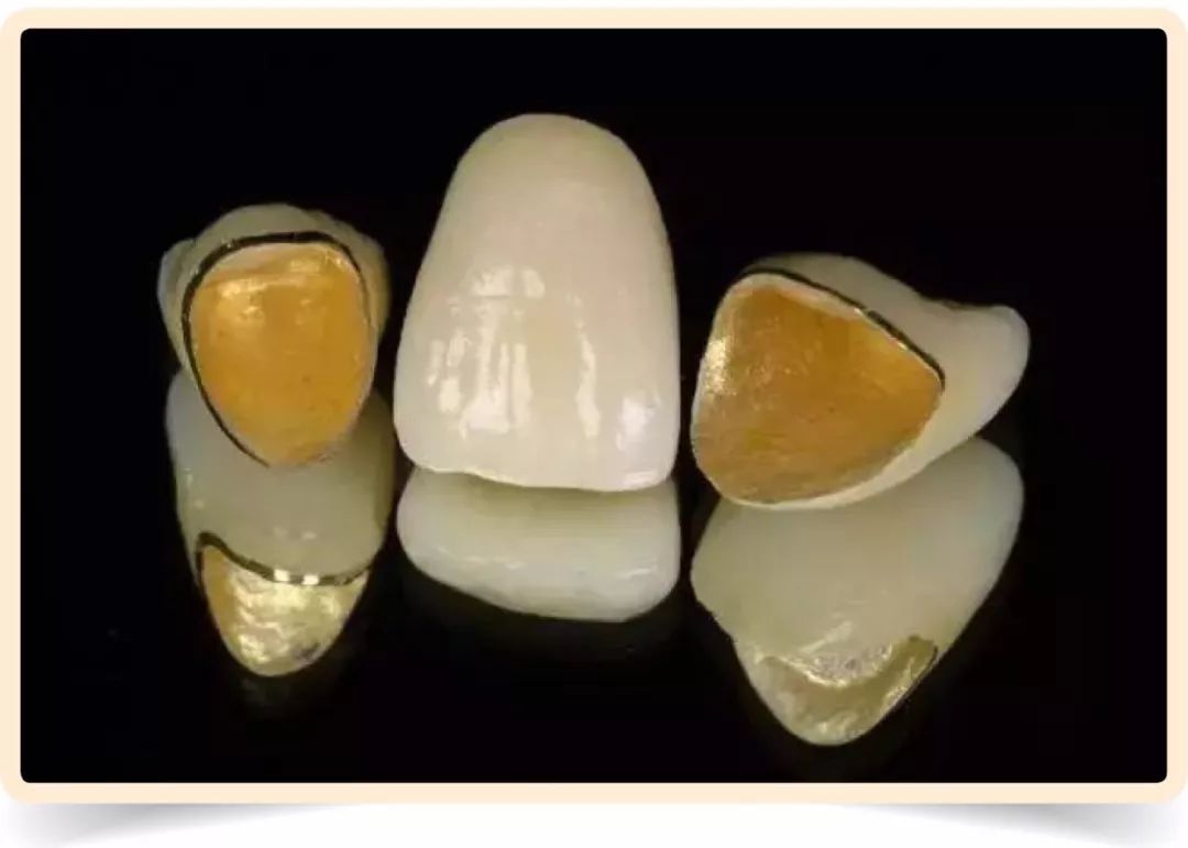 固定镶牙,口腔诊疗项目,镶牙,牙科网www.yadashi.com
