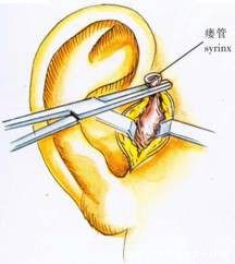 带您全面了解耳前瘘管知识