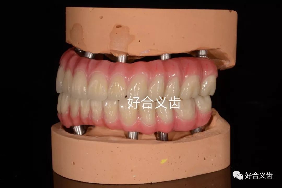 全口无牙颌种植上部修复,钛基低桥架十氧化锆冠.