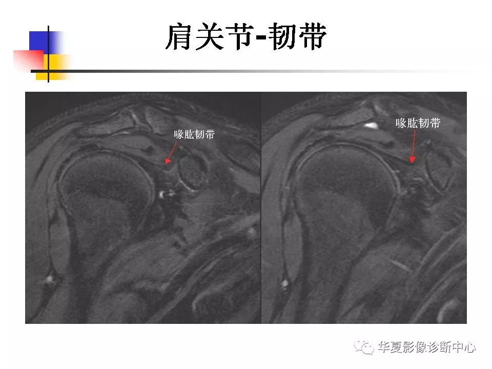 肩关节病变mri解剖与诊断