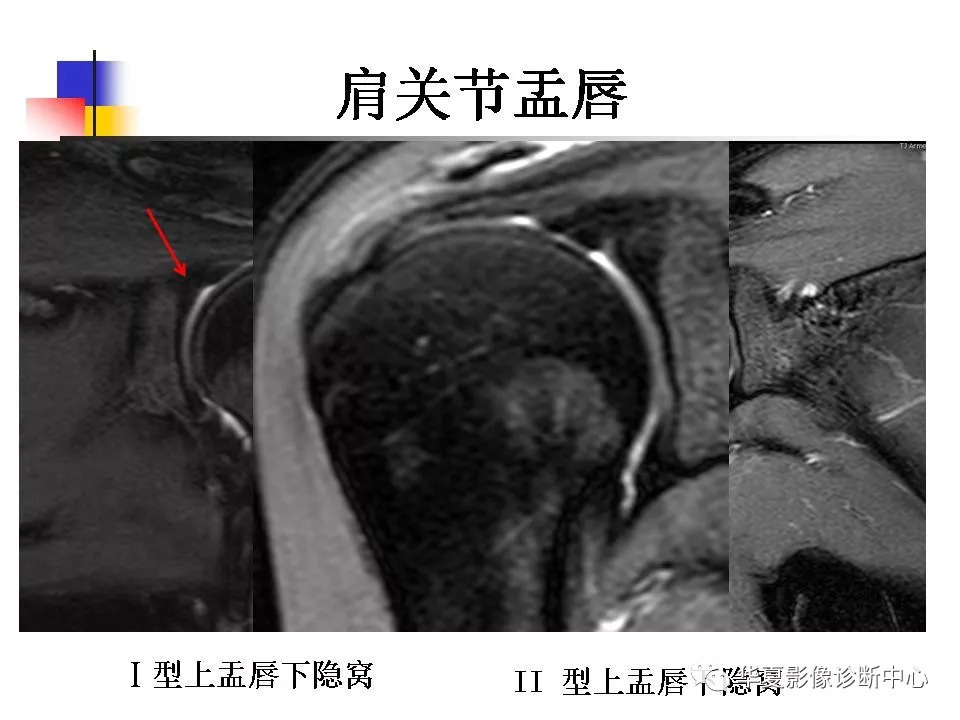 肩关节病变mri解剖与诊断