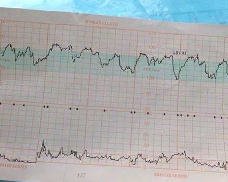 胎心监护图上2个数据曲线或许会告诉你胎宝的小秘密