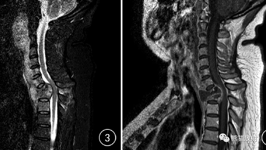 脊柱结核和非结核性脊柱炎丨mri鉴别诊断
