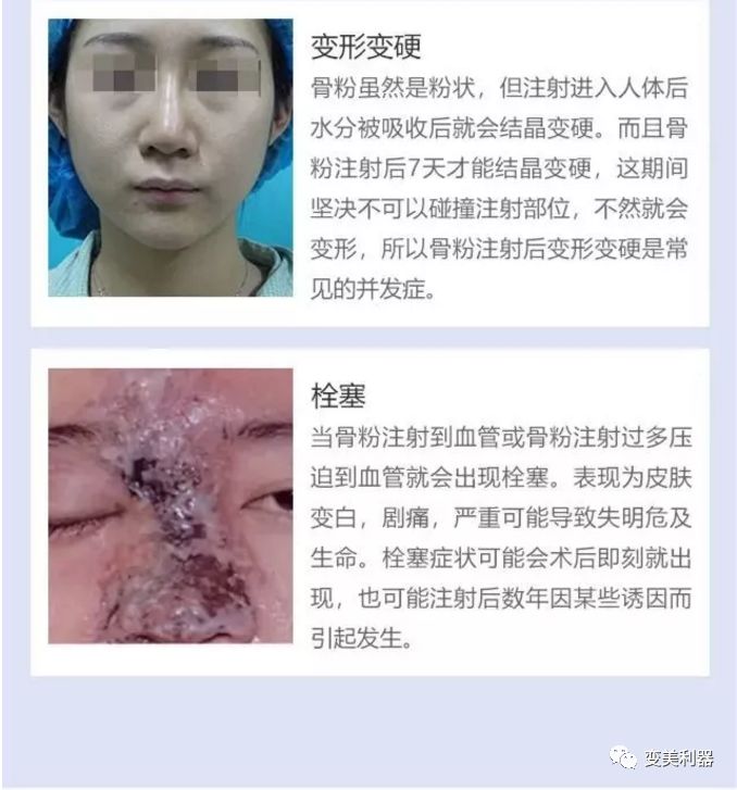 除了骨粉,奥美定,我们还向自己身体注射过什么奇葩东西?_玻尿酸