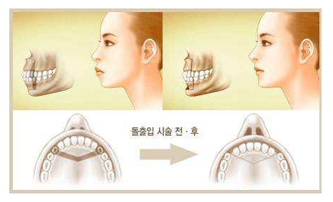 不拔牙的情况下截上颚骨 上颚骨靠后的位置