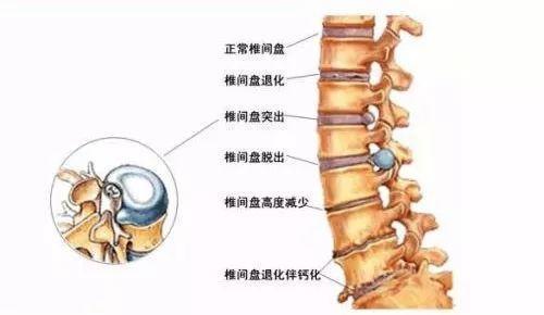 为什么越来越多年轻人也有腰椎间盘突出？_腰椎间盘突出症状