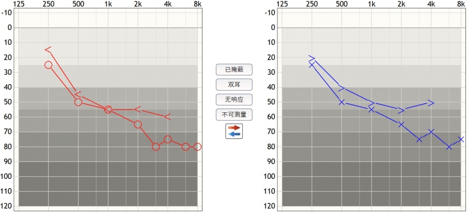 下降,逐渐波及4000～6000hz中频,亦可因基底膜破裂而高频音突然丧失