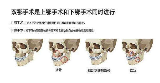 上颚和下颚的切口: 1下颚:磨牙的后侧