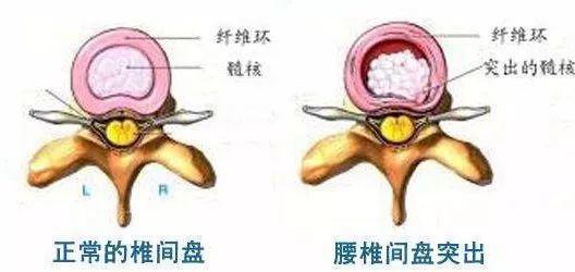 为什么越来越多年轻人也有腰椎间盘突出？_腰椎间盘突出症状