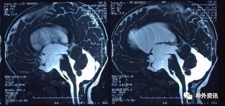 贝朗时间第三十四期丨张冰克教授鞍上池蛛网膜囊肿造瘘后分流一例