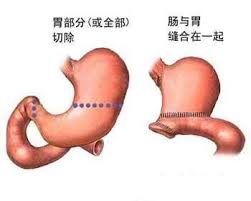 胃割掉以后怎么办