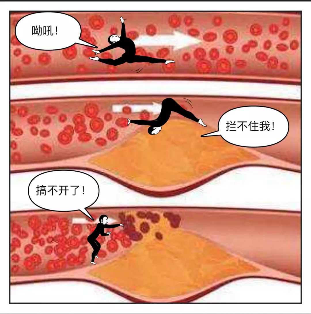 漫画科普——脑血管狭窄!脑梗死患者的不定时炸弹!