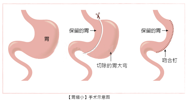 胃割掉以后怎么办