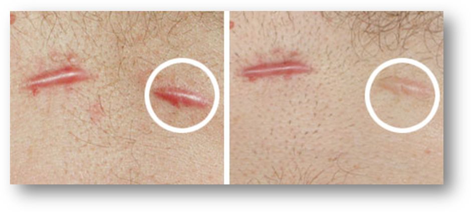 想靠外用护肤品祛疤真正有效的祛疤方法明明是这些
