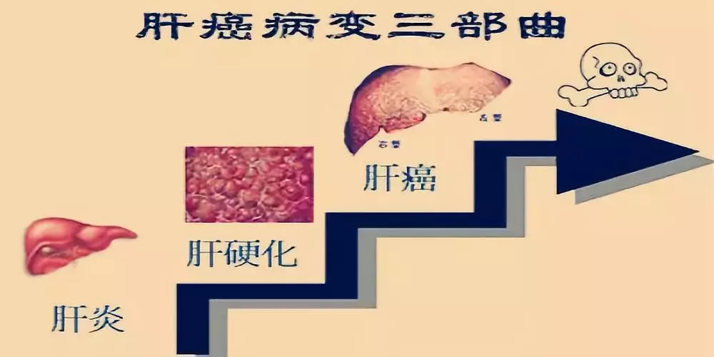 危害一:乙肝病毒长期存在体内,引起慢性肝炎