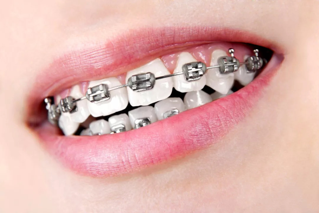作为目前最广泛应用的矫治器,在选择普通金属牙套时可以参考如下几点