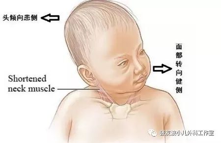 如果斜颈早期未得到有效治疗,1岁后即会面部不对称,即大小脸