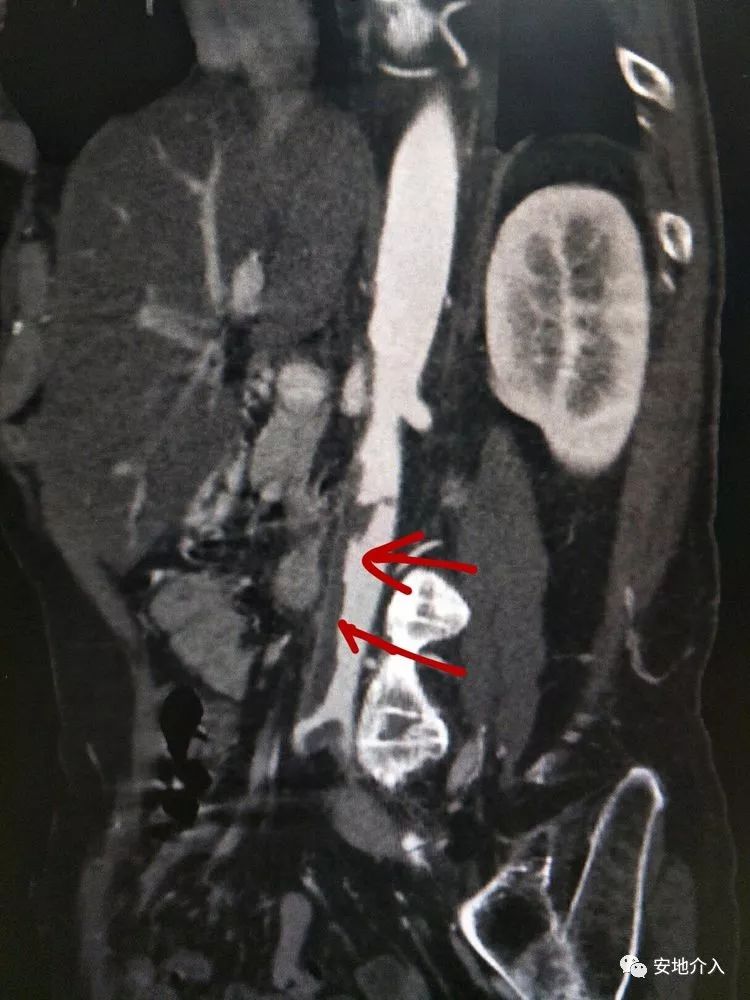 左腘动脉闭塞造影显示血栓位置: 腹主动脉骑跨栓(红),左髂内动脉血栓