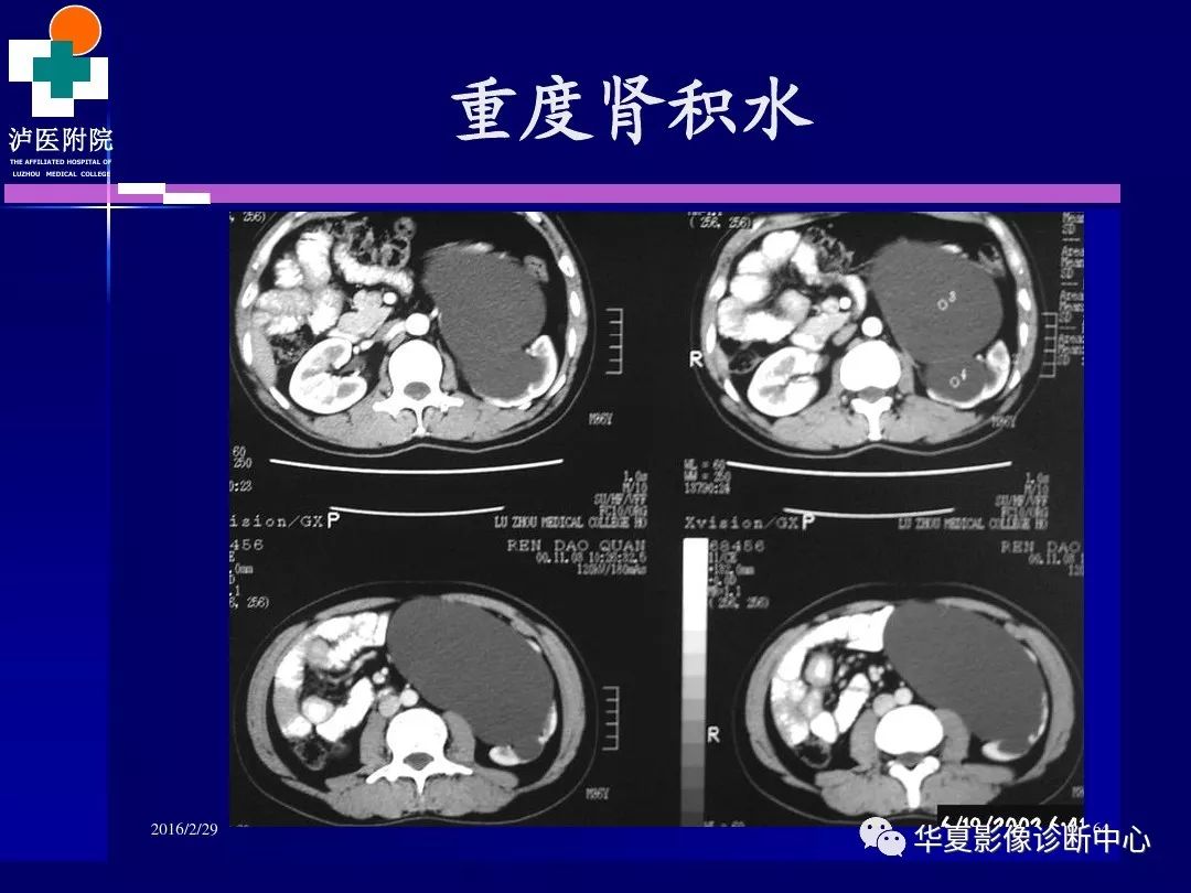 肾脏病变ct诊断全面经典解析