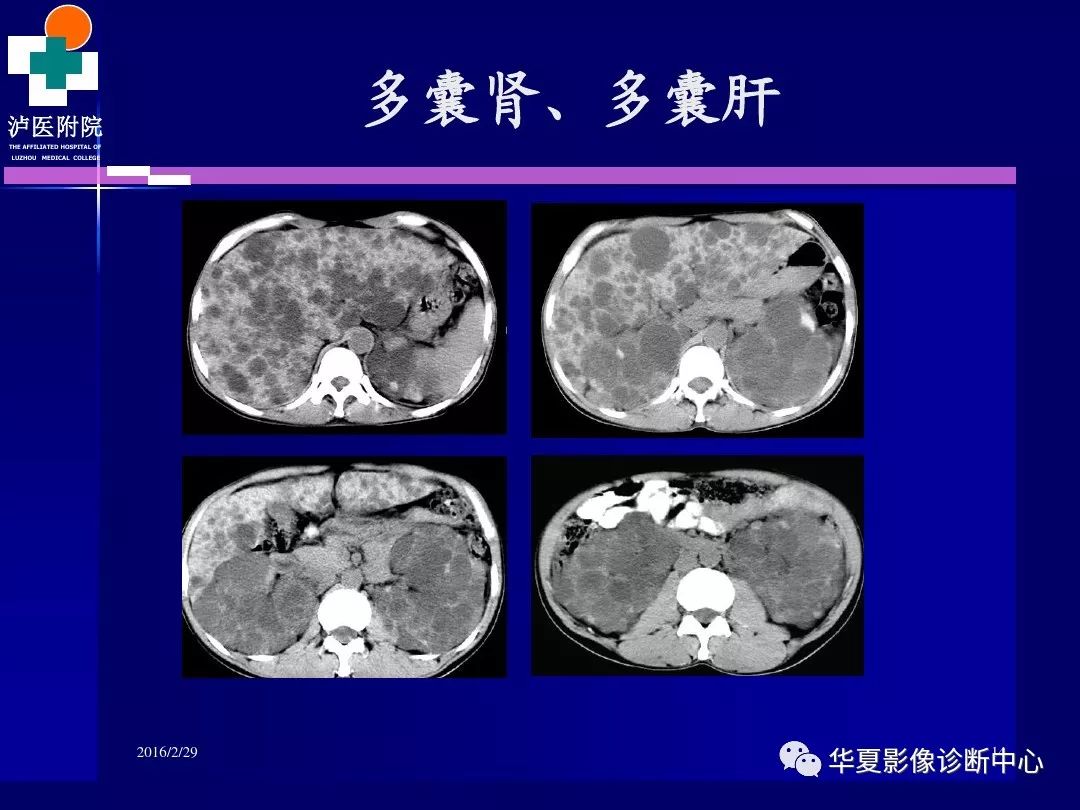 肾脏病变ct诊断全面经典解析