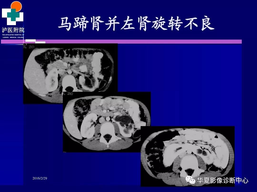 肾脏病变ct诊断全面经典解析