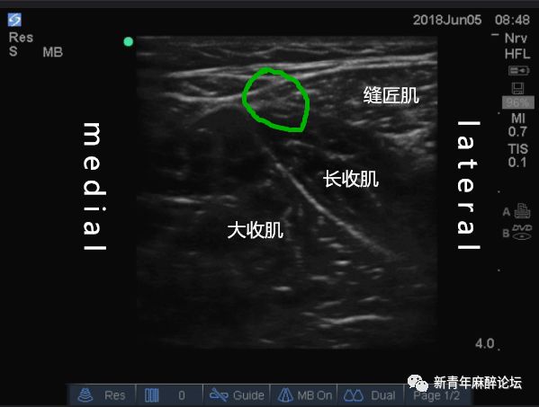 超声引导远端收肌管阻滞在全膝关节置换手术tka术后镇痛中的运用