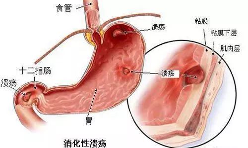 胃老是痛怎么办