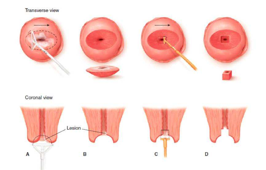 致自己:hpv16高危 宫颈瘤变iii级,宫颈锥切我挺过来了,生活真好!