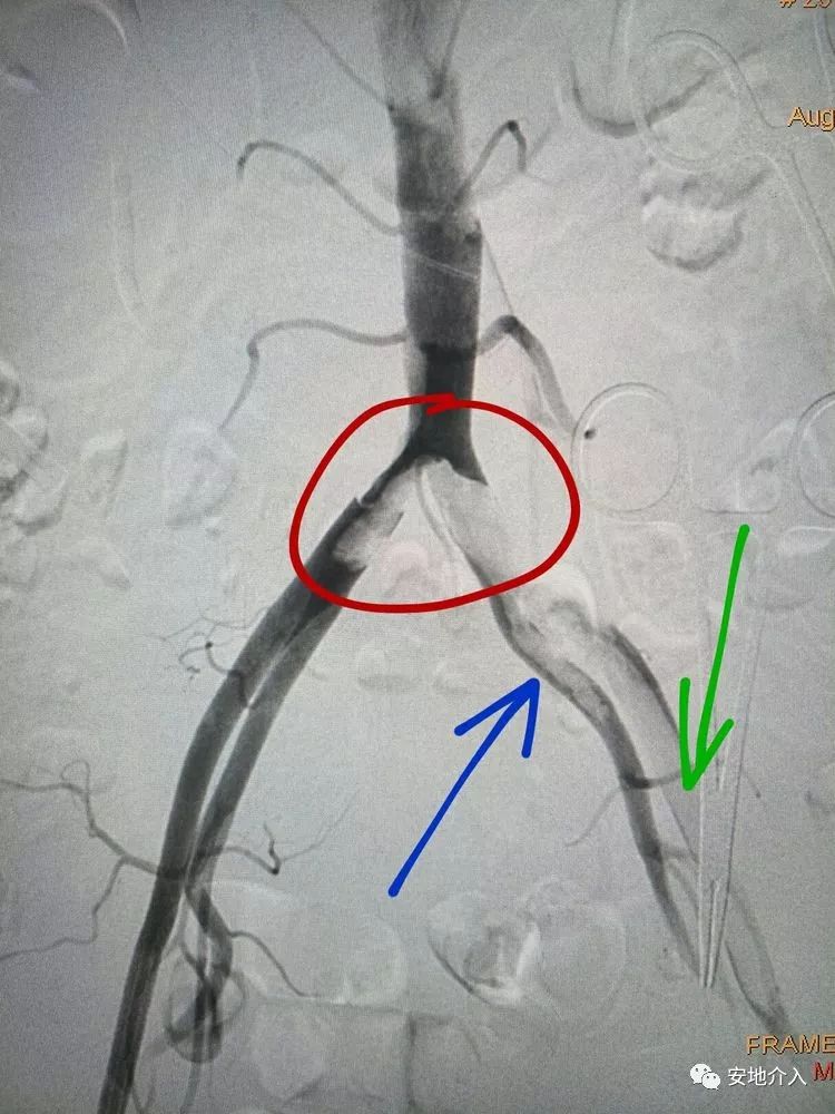 造影显示血栓位置: 腹主动脉骑跨栓(红),左髂内动脉血栓(篮),左髂外