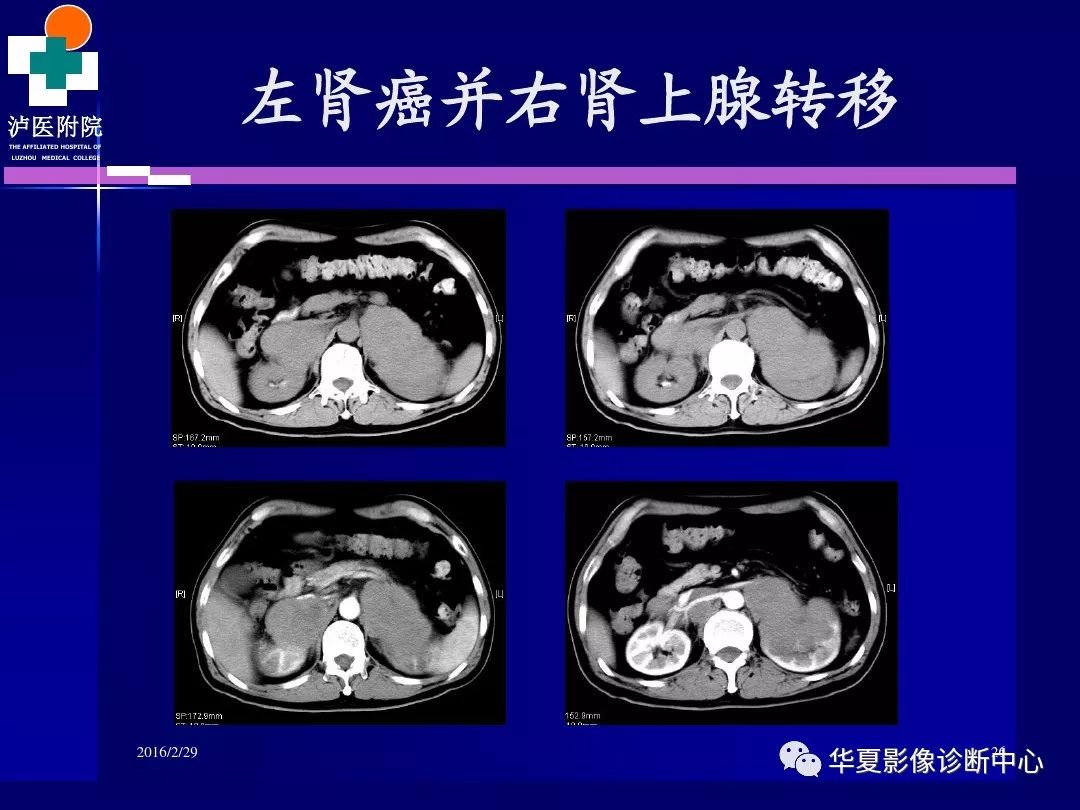 肾脏病变ct诊断全面经典解析