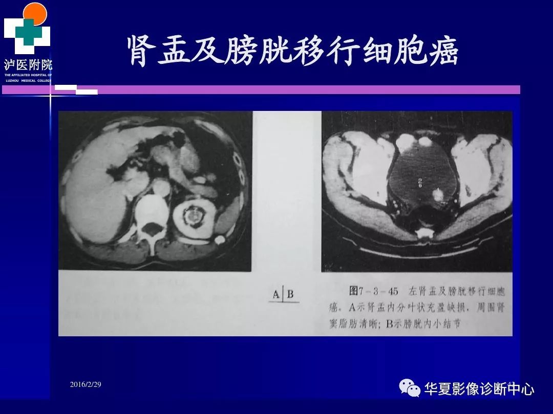 肾脏病变ct诊断全面经典解析