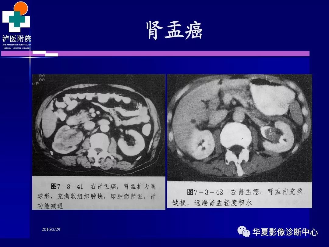 肾脏病变ct诊断全面经典解析