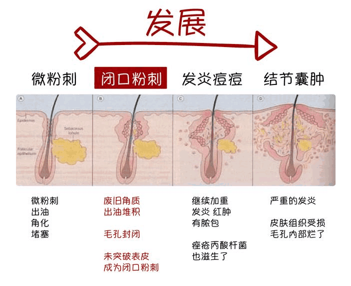 闭口人口_闭口粉刺图片