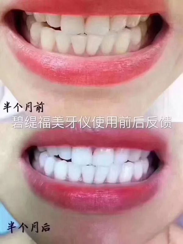 美牙仪牙托进水怎么办