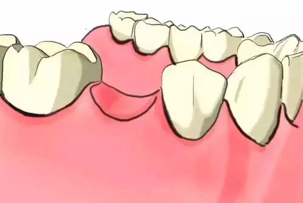 盘点缺牙的危害!_牙齿